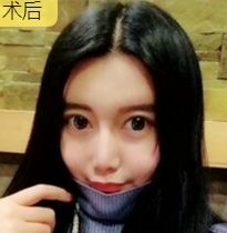 隆鼻手术