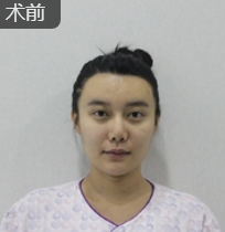 隆鼻手术