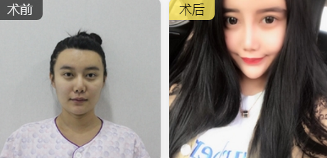 隆鼻手术