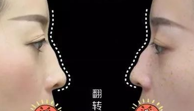 隆鼻手术