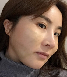面部提升术