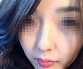 超声波瘦脸