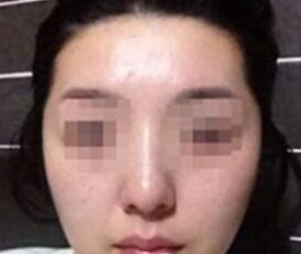 超声波瘦脸
