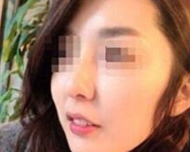 超声波瘦脸