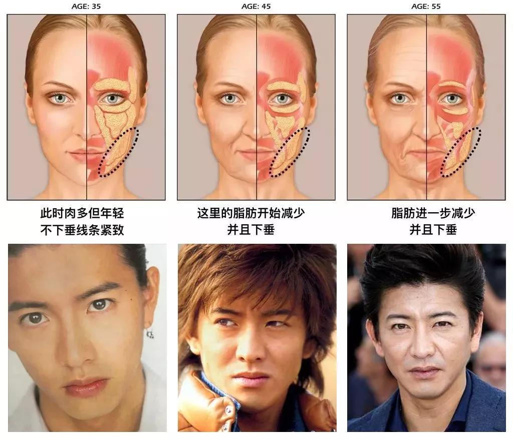 面部提升术