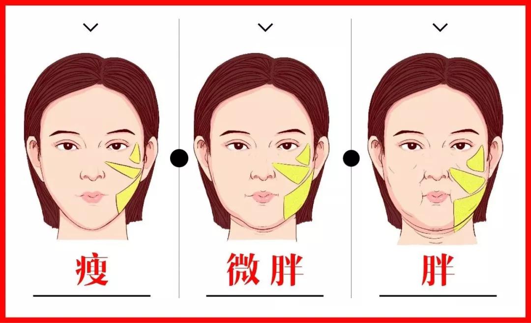 面部提升术