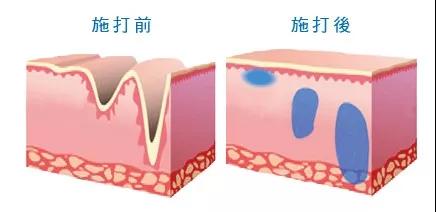 面部提升术