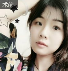 不开刀下巴延长术