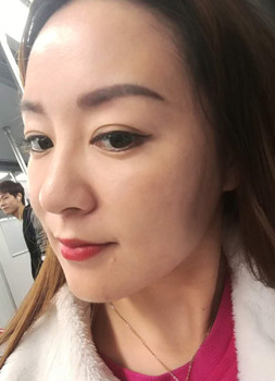 面部提升术
