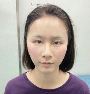 自体脂肪填充术