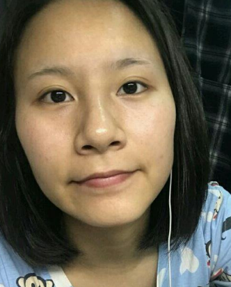 自体脂肪填充术