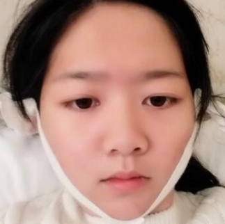 超声波瘦脸