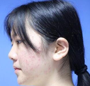 超声波瘦脸