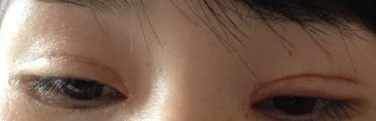 双眼皮手术