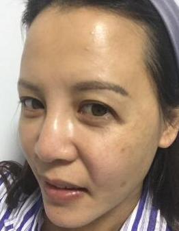 面部提升术