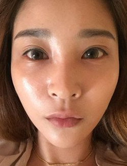 面部提升术
