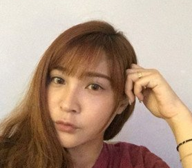 面部提升术