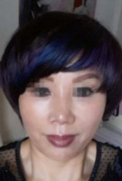 面部提升术