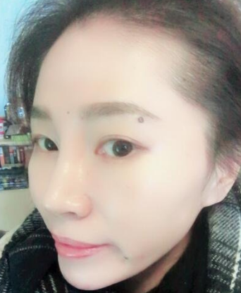 面部提升术