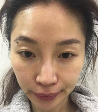 面部提升术