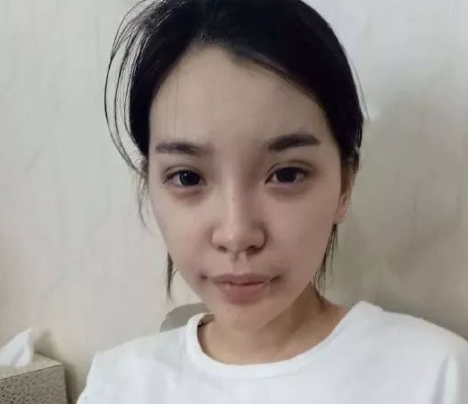 隆鼻手术
