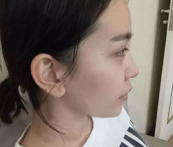 隆鼻手术