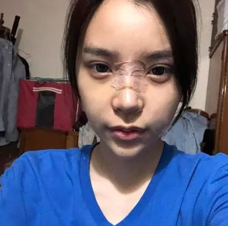隆鼻手术