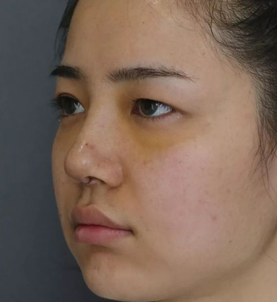隆鼻手术