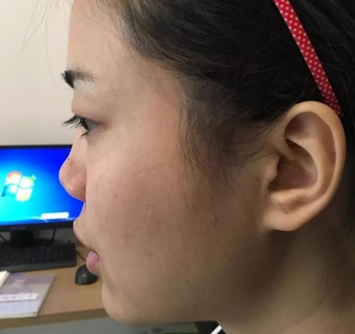 隆鼻手术