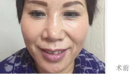 超级微拉美