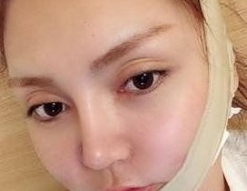 超声波瘦脸