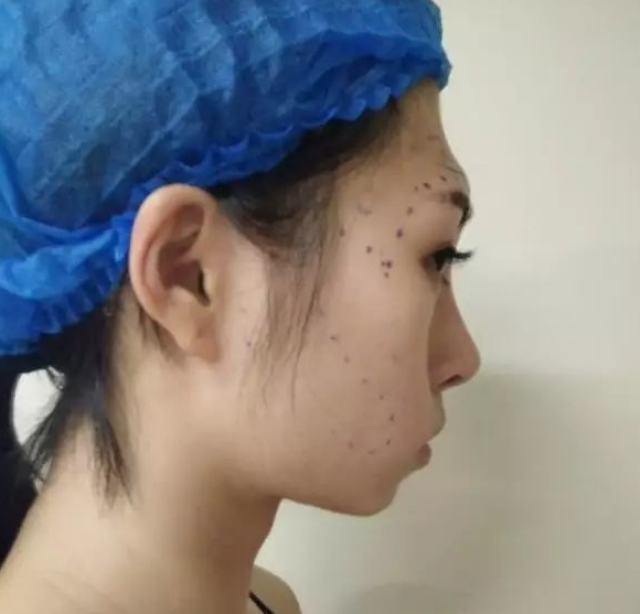 自体脂肪填充术