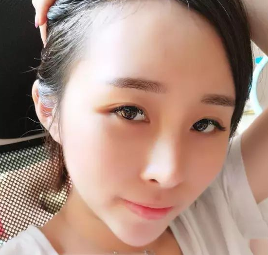 自体脂肪填充术