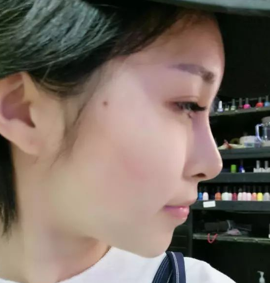 自体脂肪填充术