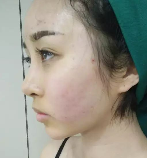 自体脂肪填充术