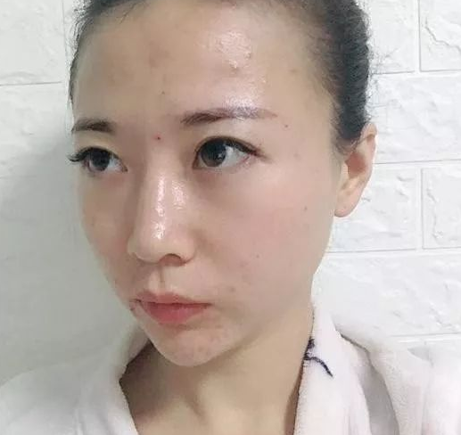自体脂肪填充术