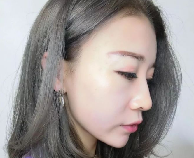 自体脂肪填充术