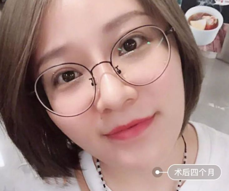 自体脂肪填充术