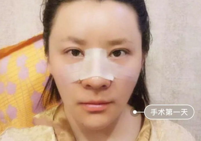 自体脂肪填充术
