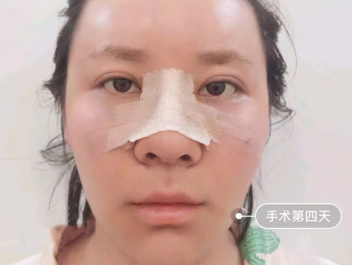 自体脂肪填充术