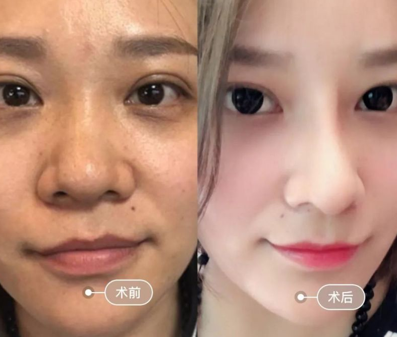 自体脂肪填充术