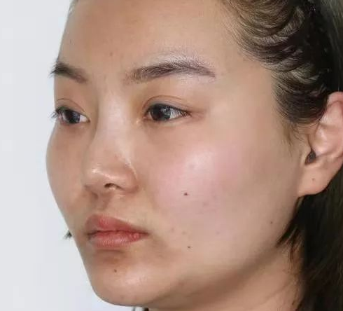超声波瘦脸