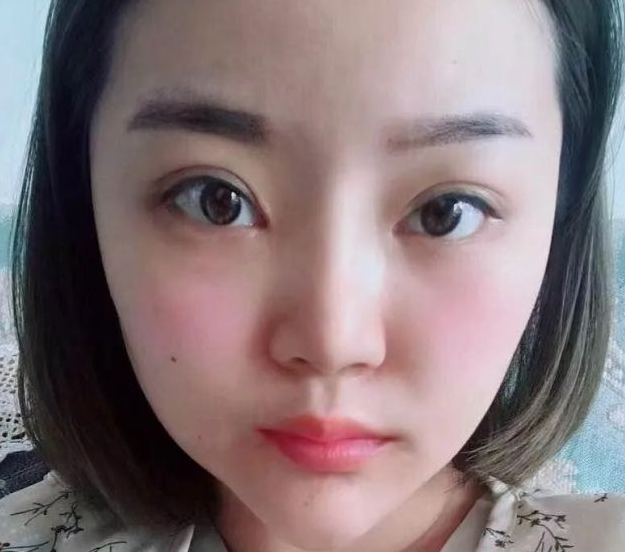 超声波瘦脸
