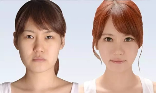 吸脂瘦脸