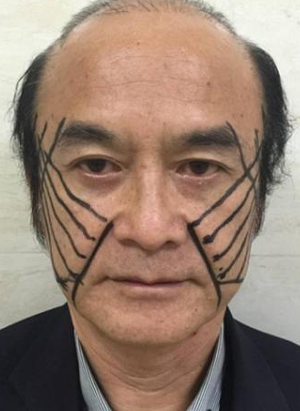 面部提升术