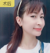面部提升术