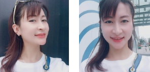 面部提升术