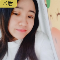 面部提升术