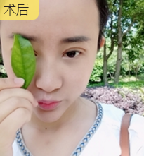 面部提升术