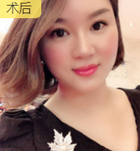 面部提升术